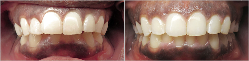 smile gallery picture